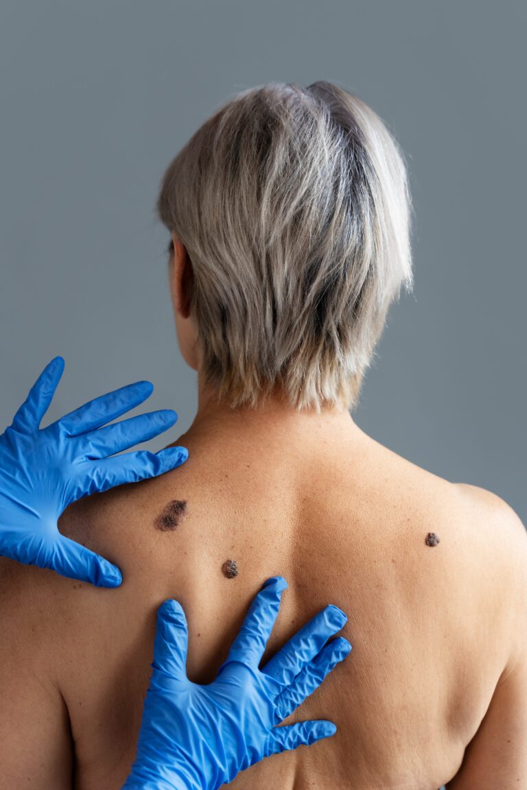 <p>Supporting Melanoma Patients with Natural Therapies</p>
