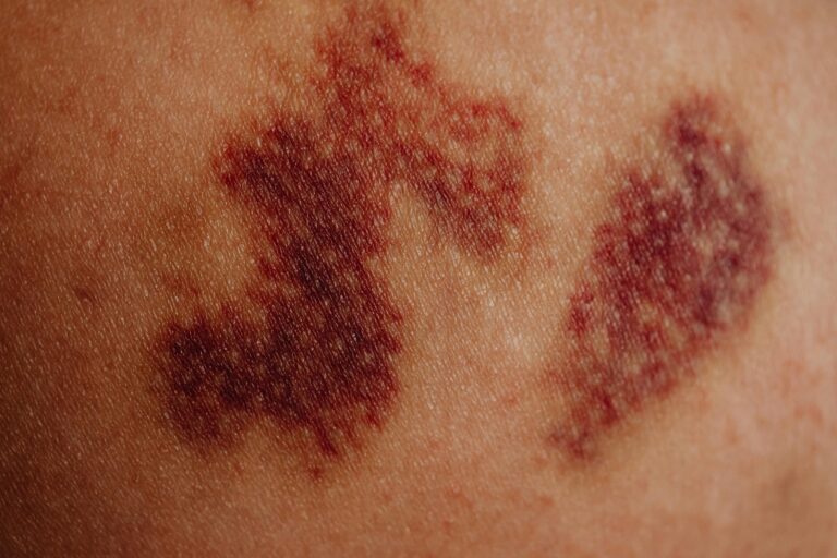 <p>Blood Cancer </p>
<p>Blood Cancer </p>