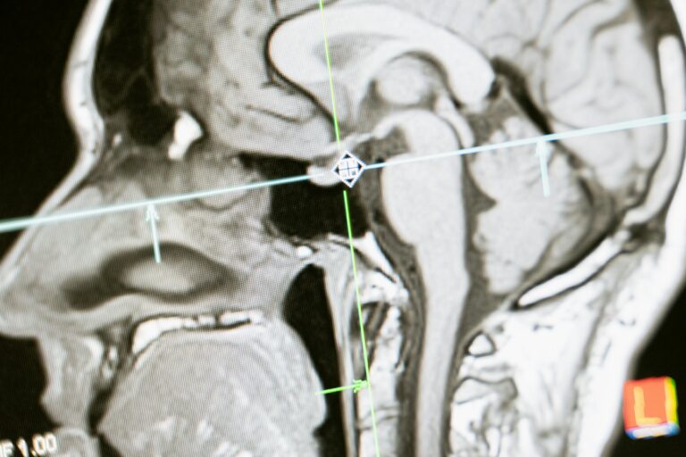 <p>managing the chemo brain </p>
<p>managing the chemo brain </p>